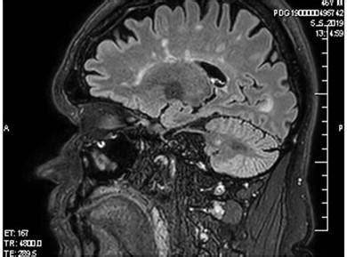 MRI mozgu s kortikálnou atrofiou