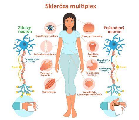 Poškodenie myelínu pri roztrúsenej skleróze