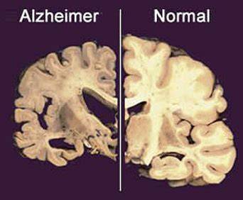 Tréning mozgu a Alzheimerova choroba