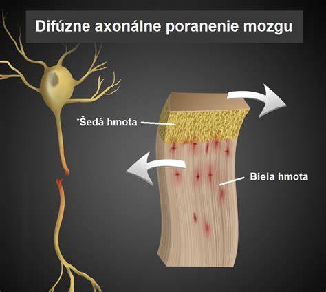 Difúzne axonálne poškodenie mozgu
