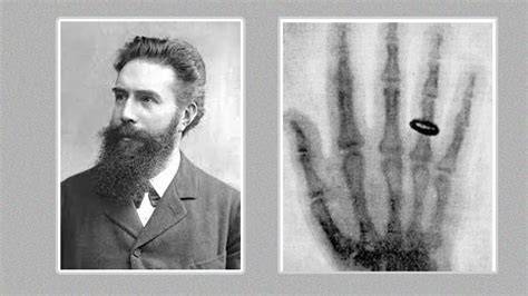 Wilhelm Conrad Röntgen prvá röntgenová snímka