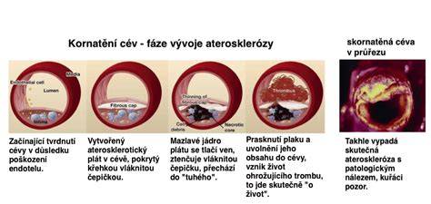 Aterosklerotický plak v tepne