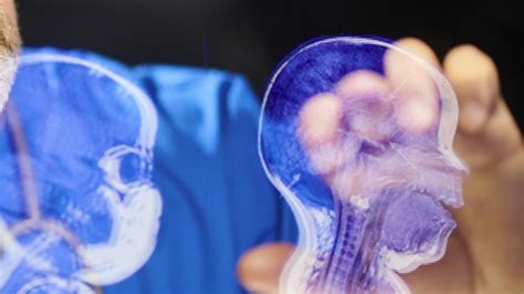 Neurorehabilitácia pacienta po operácii mozgu