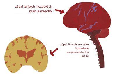 šírenie infekcie z hrdla do mozgových blán