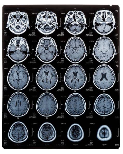 Porovnanie CT a MRI mozgu