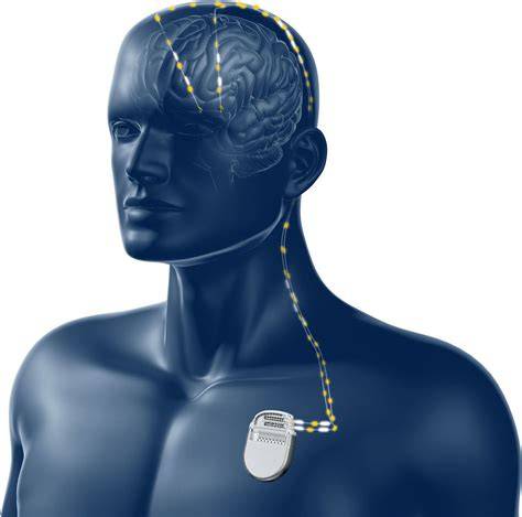 Schéma implantácie elektród a neurostimulátora