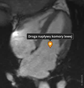 MRI koloidnej cysty tretej komory