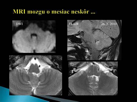 MRI lézie sivej hmoty pri SM
