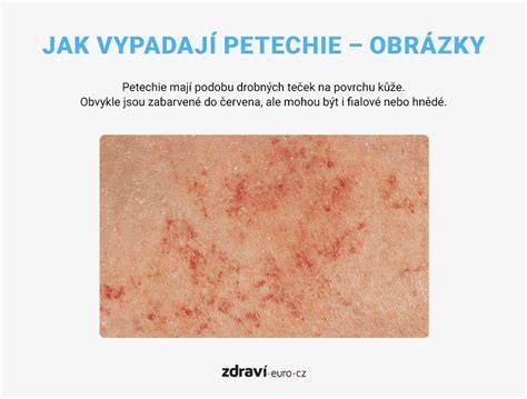 Petechie a sklíčkový test vyrážky