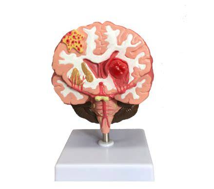 3D model mozgovej arteriovenóznej malformácie