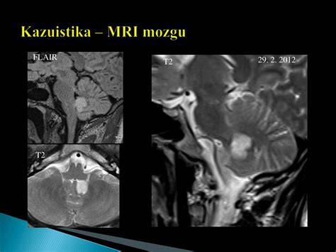 MRI lézie bielej hmoty mozgu