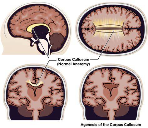 Mozgové hemisféry a corpus callosum