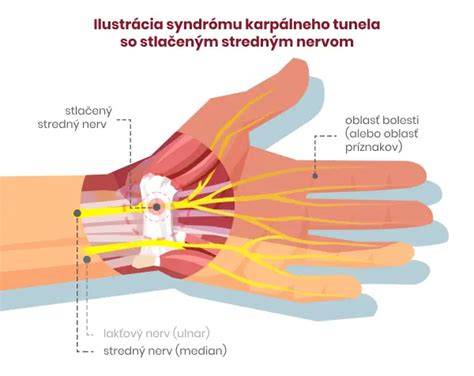 Umiestnenie karpálneho tunela v zápästí