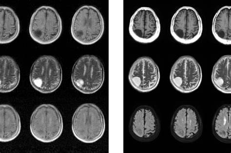 Moderné zobrazovanie štruktúry mozgu MRI