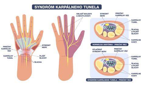 Anatomia karpálneho tunela a stredový nerv