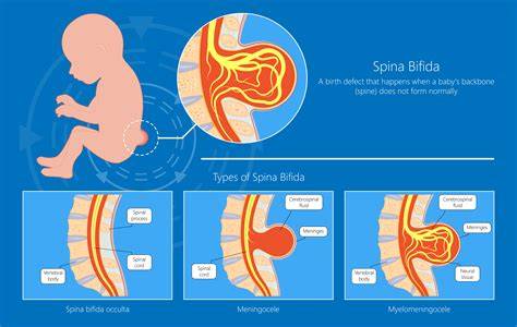 Schéma meningomyelokély a spina bifida