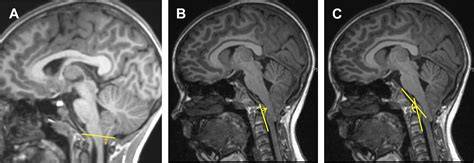 Chiariho malformácia herniácia tonzíl MRI