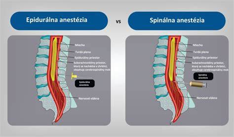 spinálna anestézia anatomická schéma
