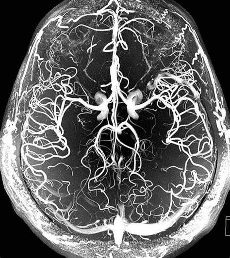 3D angiografia mozgových žíl