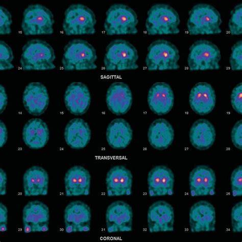 DaTSCAN SPECT mozgu dopamínové transportéry