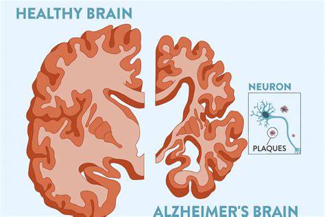 Alzheimerova choroba a fázy demencie