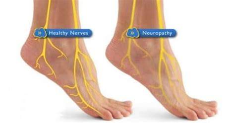 Proximálna diabetická neuropatia oblasti stehna