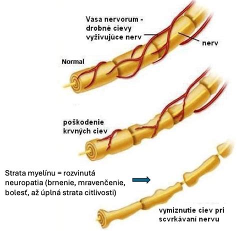 Poškodenie nervu a strata myelínového obalu