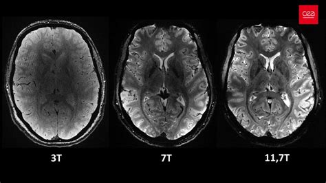 MRI mozgu pri rôznych typoch demencie