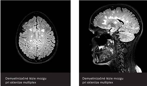 MRI lézie pri skleróze multiplex