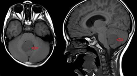 MRI snímka glioblastómu v mozgu