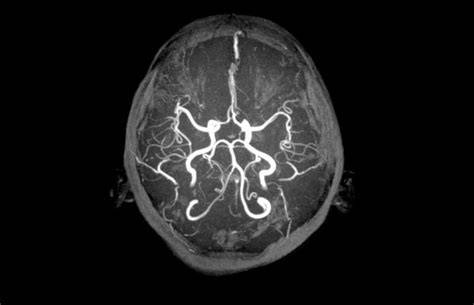 Arteriovenózna malformácia v mozgu schéma