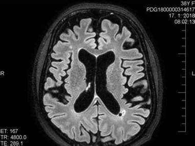 MRI kortikálnej atrofie mozgu porovnanie