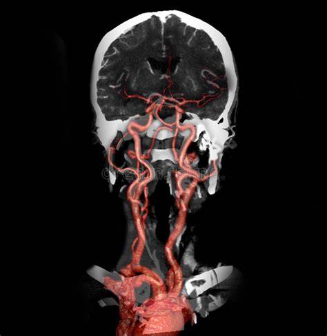 3D CT angiografia mozgových ciev