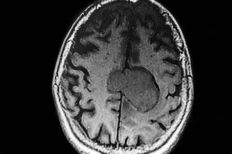 epidermoidná cysta mozgu MRI