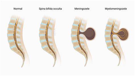 typy spina bifida anatomická schéma