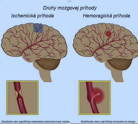 Schéma ischemickej a hemoragickej mozgovej príhody