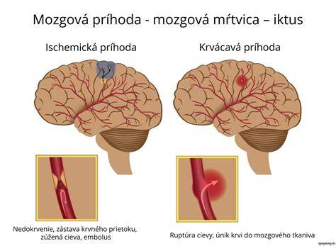 ischemická a hemoragická mozgová príhoda schéma