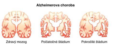 Alzheimerova choroba amyloidné plaky mozog